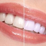 3 Quick Ways For Natural Teeth Whitening image-2083