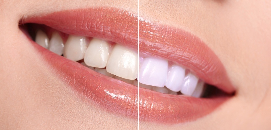 Teeth-Whitening