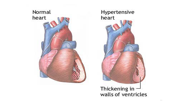 Natural Solution For High Blood Pressure (HYPERTENSION)!