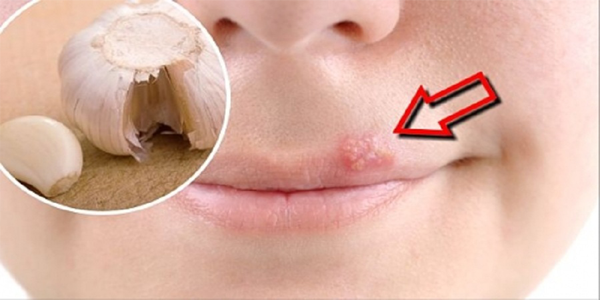Get Rid Of Herpes Using A Simple Trick
