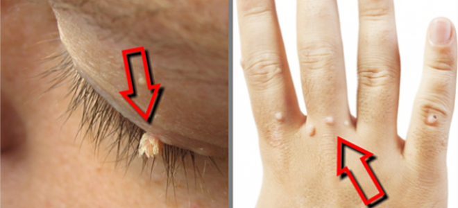 Most Effective Homemade Remedies For Removing Warts