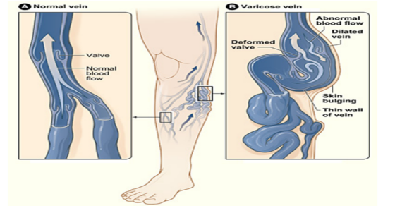 3 Amazing Home Remedies To Treat Varicose Veins Naturally