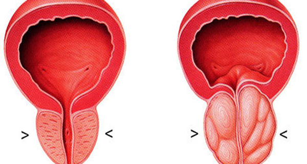 Homemade Remedy For Enlarged Prostate And Prostate Cancer