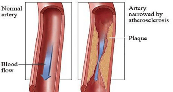 How To Clean Your Arteries With One Simple Fruit