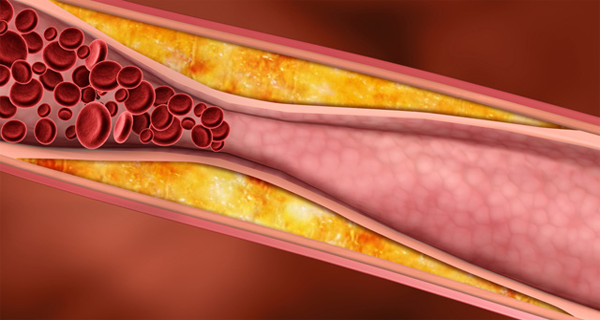 4 Silent Signs You May Have Clogged Arteries And The Best Foods To Eat To Prevent It
