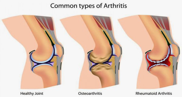 Best Home Remedy for Joint Inflammation