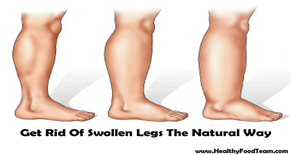 Get Rid Of Swollen Legs The Natural Way