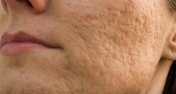 Home Remedies For Acne Scars Removal