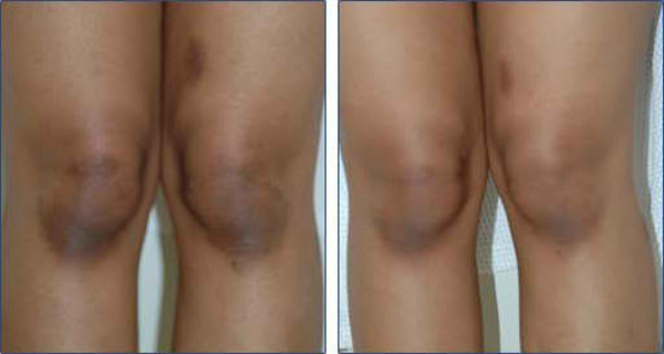 How To Get Rid Of Black Knees And Elbows