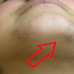 How To Remove The Facial Hair In A Natural Way? Epilation At Home! image-3440