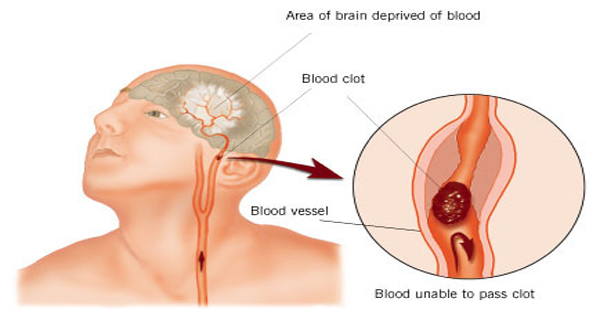 Knowing The Symptoms Of a Stroke Could Save Your Life