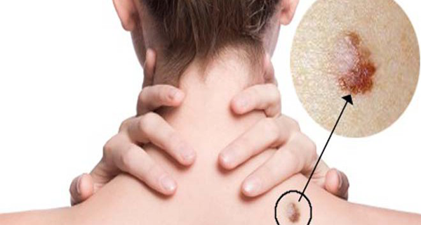 These Are The Hidden Symptoms Of Sexually Transmitted Disease!