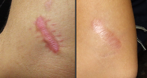 10 Natural Remedies to Remove Keloids