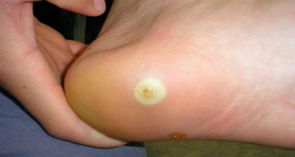 FINALLY! A Tested Recipe For Removal of Corns and Calluses!