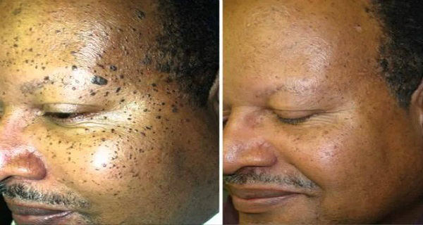 Get Rid Of Your Moles With These Natural Remedies