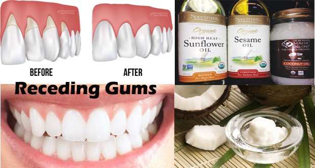 Natural-Home-Remedies-for-Receding-Gums-620x330