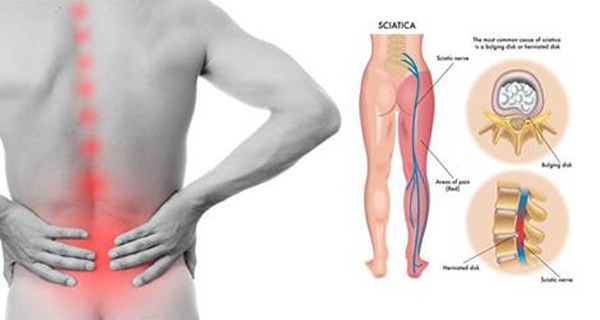 Simple Yoga Stretches For Relieving Chronic Sciatica Pain