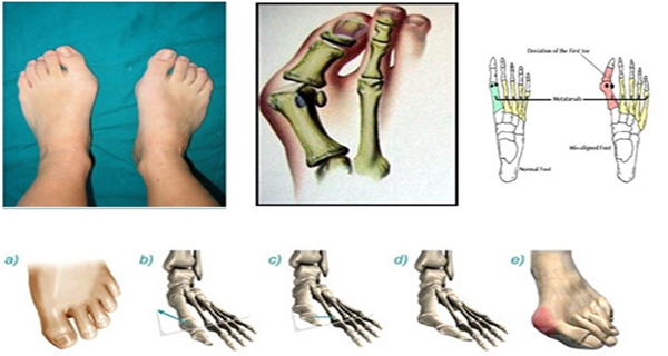 These Are The Causes Of Toes Deformities