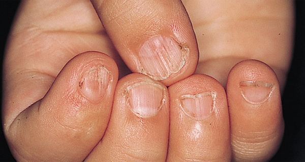 Warning Your Nails Might Be Pointing To A Disease, 5 Symptoms That Are Good To Know