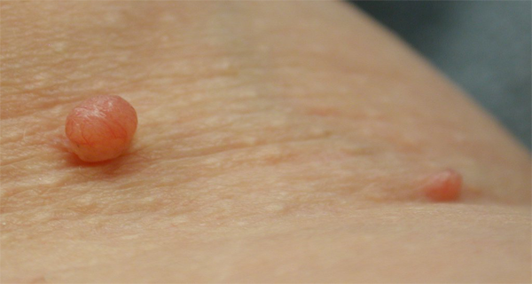 8 Home Remedies To Remove Skin Tags