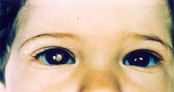DANGER! If Only One Eye Is Red When Taking A Picture, Visit Your Doctor Immediately!