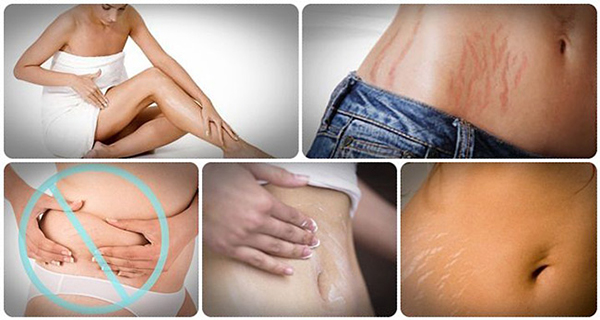 How to Get Rid Of Stretch Marks Naturally and Fast
