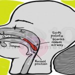 How to Stop Snoring image-4388