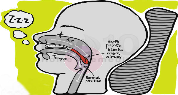 How to Stop Snoring