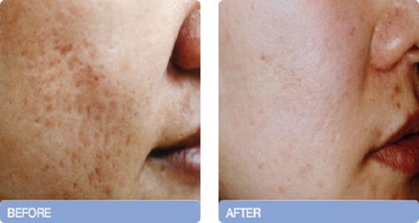 Remove Acne Scars Forever