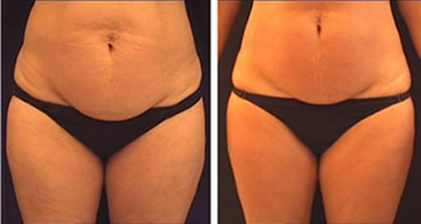 The Secret Recipe For a Drink That quickly Melt Cellulite