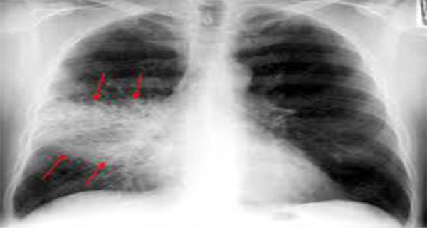 This Is How To Cure Pneumonia Naturally In Only 3 Hours!