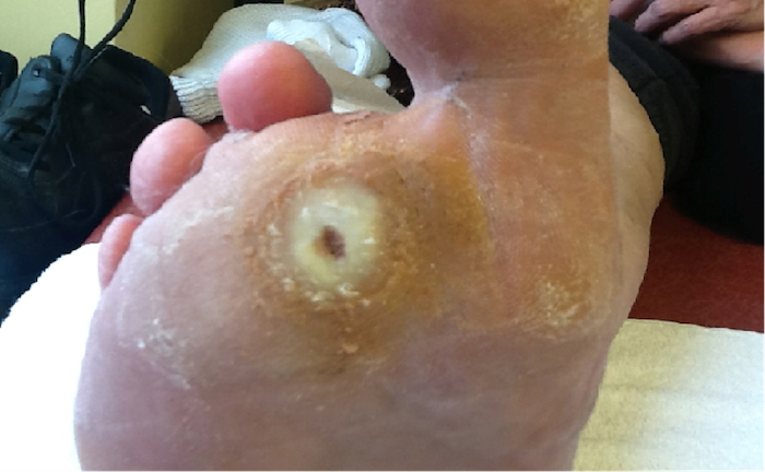 Aspirin Recipe for Callused Feet