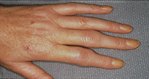 DIY-An-Ointment-That-Heals-Rheumatism-And-Gout