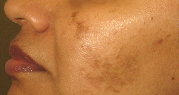 Get Rid of Stains, Freckles and Hyperpigmentation by Using This Natural Recipe Which Contains 2 Ingredients