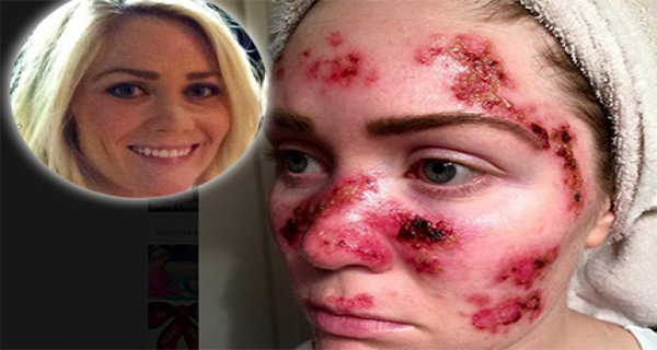 Her Life Is Hell She Got Skin Cancer Due To Solarium! This Is Her Story!