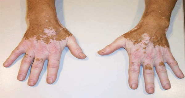 Horseradish Helps in the Treatment of Vitiligo