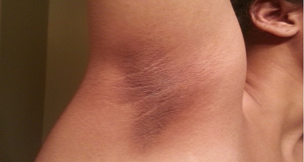 How-To-Get-Rid-of-Dark-Underarms