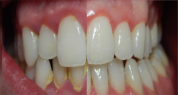 Chew On this Root to Melt Away Plaque and Prevent Cavities
