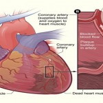 Clear Up Clogged Arteries & Eliminate Bad Cholesterol with This Natural Remedy image-5515