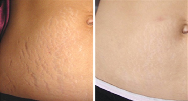 Get Rid Of Stretch Marks Naturally