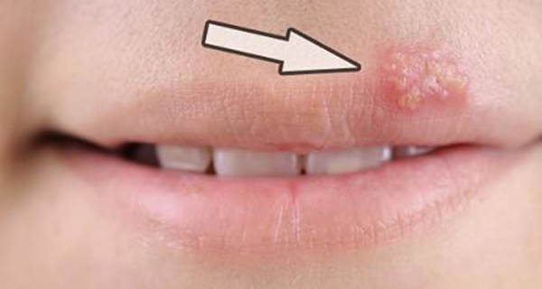 How To Get Rid Of Herpes Using A Simple Trick