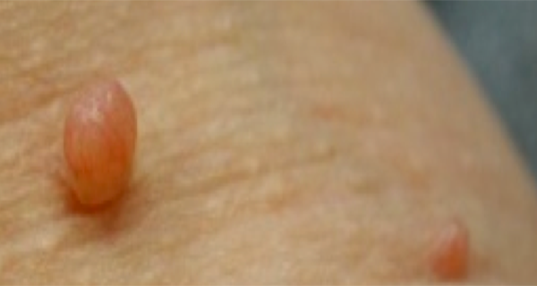 How to Remove Skin Tags Using One Simple Ingredient