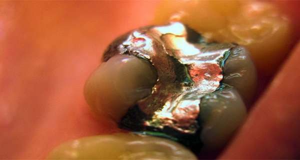 Killer in Your Mouth Remove Amalgam Fillings and You Will Be Healed Of Many Diseases