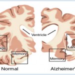 Might Alzheimer’s Disease Be “Foodborne”? image-6405