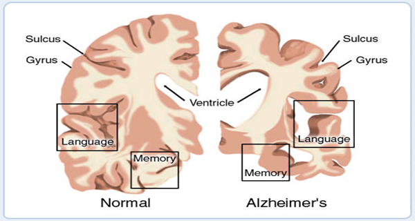 Might Alzheimers Disease Be “Foodborne”