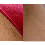 Remove Unwanted Hair Forever. Initially, the Hair Will Start to Become Thinner and Eventually Disappear Forever image-6527