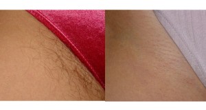 Remove Unwanted Hair Forever. Initially, the Hair Will Start to Become Thinner and Eventually Disappear Forever image-6527