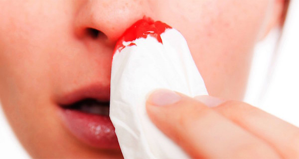 Tricks To Make Nose Bleeding Stop