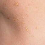 This is How To Remove Small Warts From Your Skin By Using One Ingredient image-6551