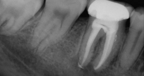 rootcanals